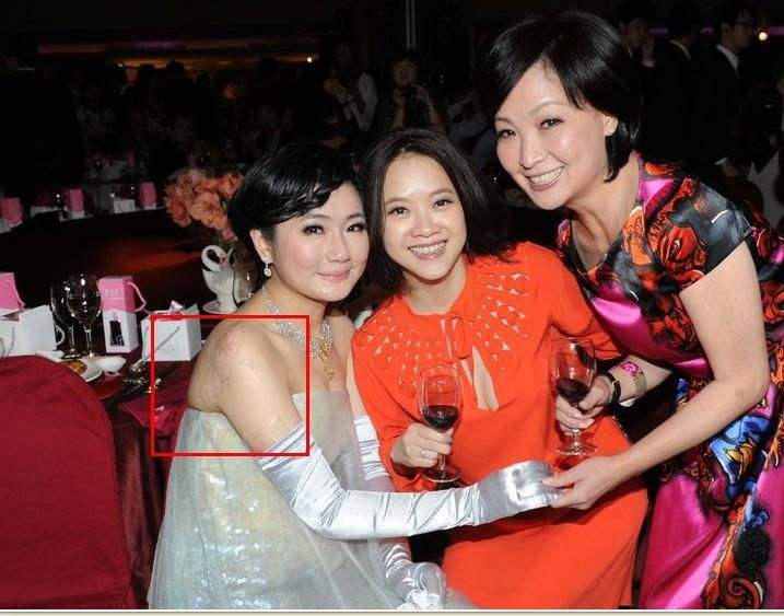 任家萱燒傷前后對比圖片觸目驚心 she任家萱怎么燒傷的賠了多少錢