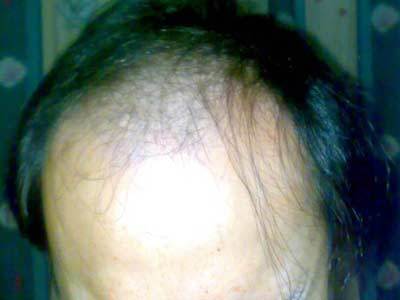 如何防止脫發